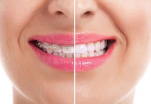Niềng răng mắc cài sứ là phương pháp chỉnh nha hiện đại
