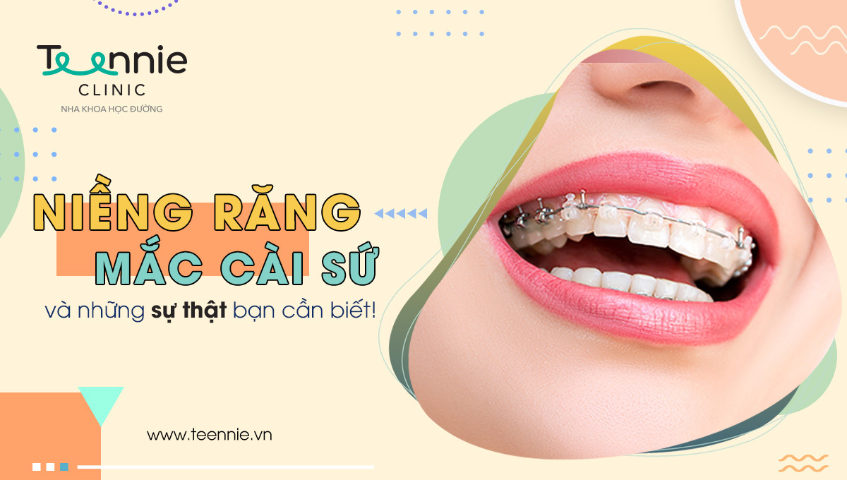 Niềng răng mắc cài sứ có thực sự tốt?