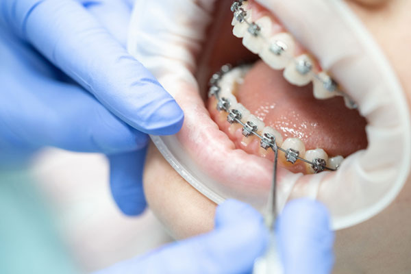 Niềng răng mang lại những lợi ích gì?